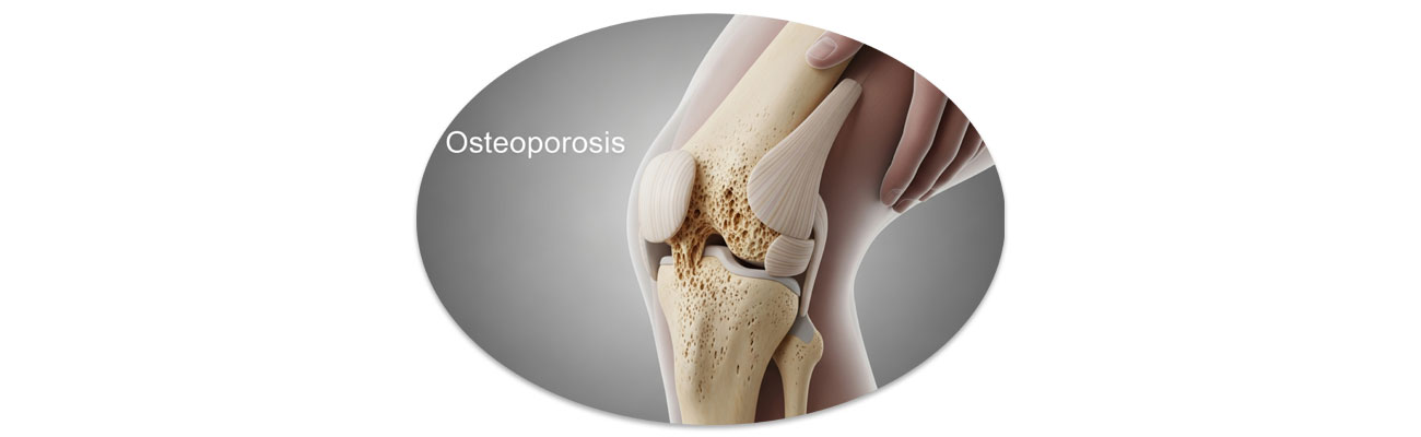 Vitamin- és ásványianyag szükségletünk - csontritkulás megelőzésére, késleltetésére